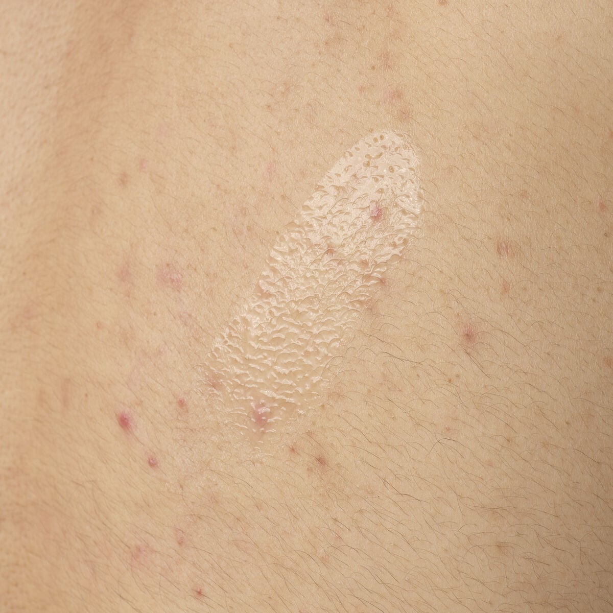 salicylic-acid-0-5-body-serum-t9 ORD-salicylic-acid-05-body-240ml-application.jpg
