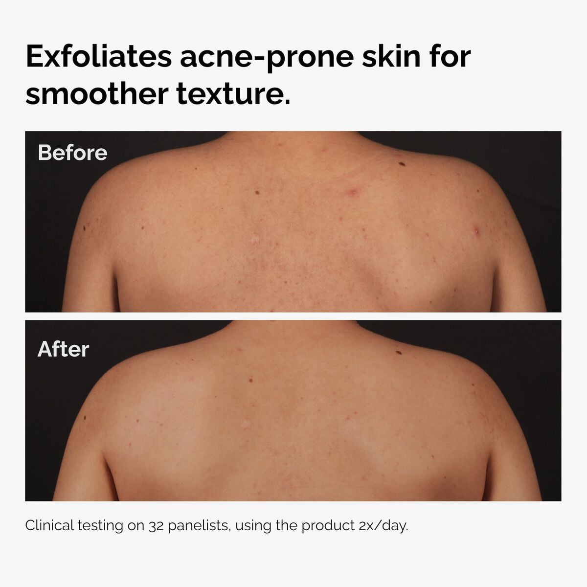 salicylic-acid-0-5-body-serum-t9 ord-salicylic-acid-body-serum-before-after-graphic-NA.jpg